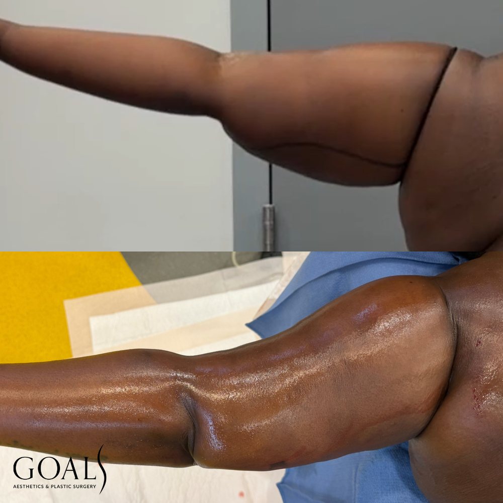 Lipedema arm before and after FlexSculpt awake liposuction