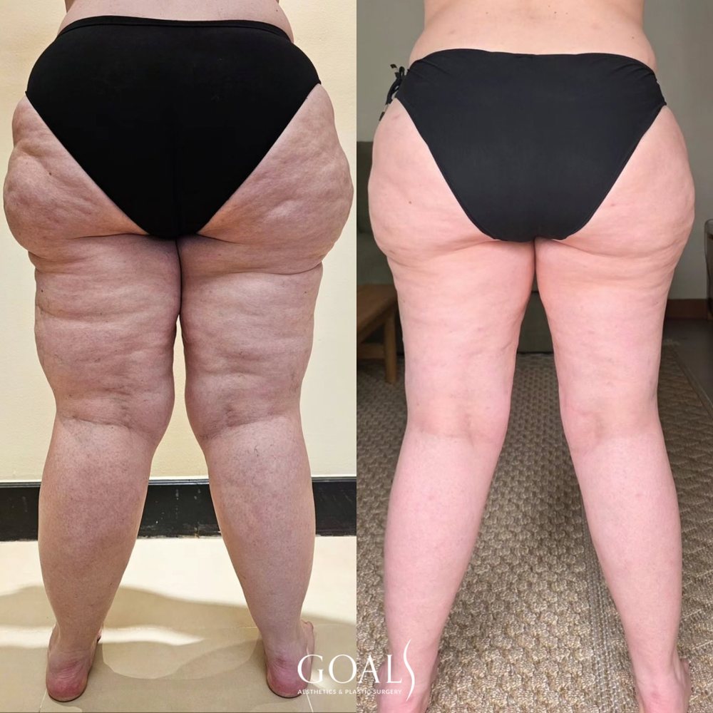 Lipedema before and after, back view of thighs and calves