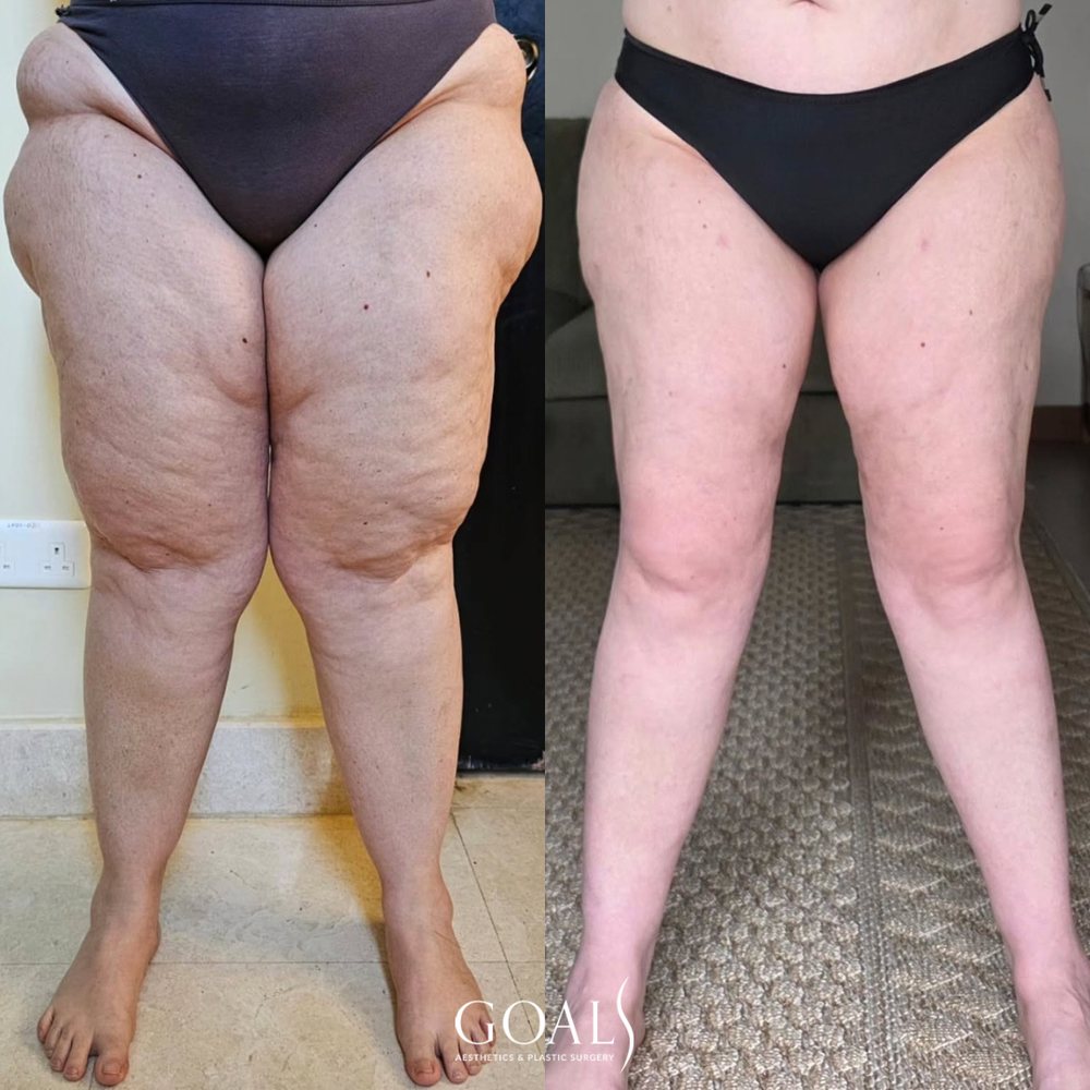 Lipedema before and after FlexSculpt awake liposuction, front view of thighs and calves