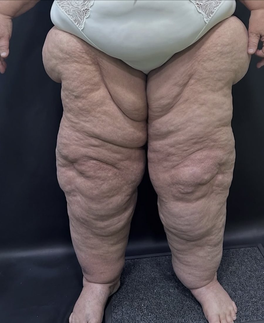 Advanced lipedema: column-shaped legs with nodular texture and fat stopping abruptly at the ankles